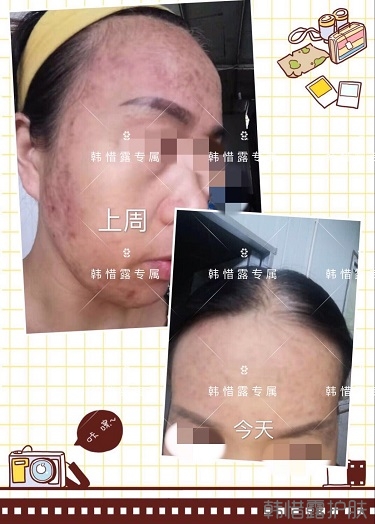 多年的粉刺痘痘，沒想到使用一周后粉刺消了這么多！