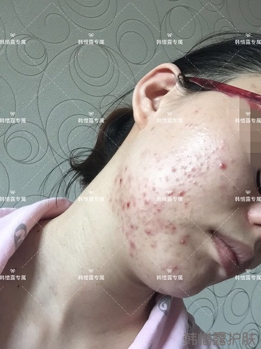 粉刺痘痘，痘印都沒了，寶媽重回顏值巔峰！