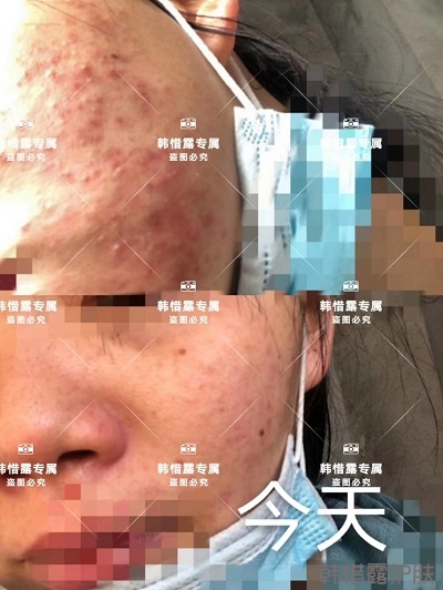 臉上長閉口粉刺怎么去除,粉刺消下去了，皮膚變好了