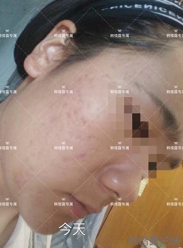 好好使用，膿包痘痘,小粉刺全消了,重點修復(fù)痘印痘坑印了