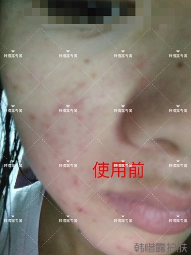 額頭長(zhǎng)痘臉頰長(zhǎng)痘痘粉刺，這樣調(diào)理幫你恢復(fù)嫩白肌膚！