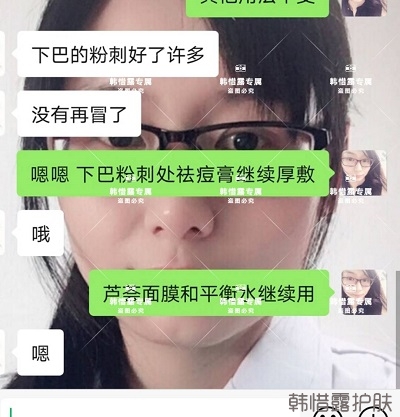 閉口粉刺怎么去除，下巴粉刺好了許多，粉刺沒有再長(zhǎng)了