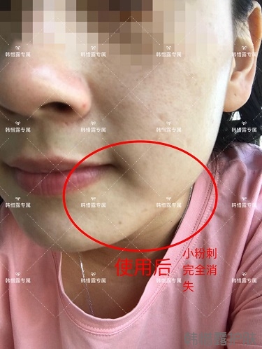 粉刺密密麻麻，試過很多方法無果后找韓惜露老師輕松去掉粉刺！