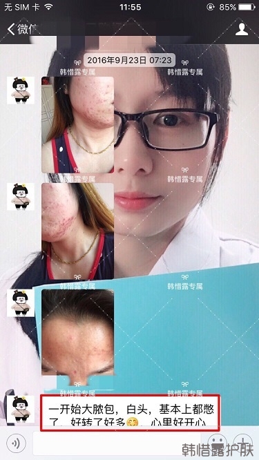 下巴長痘怎么辦？看這里徹底去掉痘痘，不再長痘了！