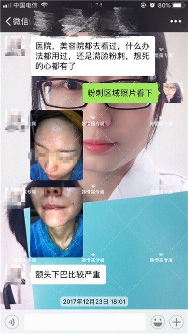 【視頻】臉上長(zhǎng)粉刺怎樣去掉？醫(yī)院都沒搞定韓惜露幫我搞定了，超級(jí)開心！