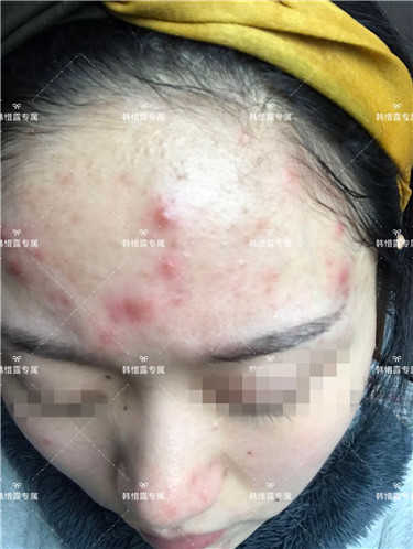 【視頻】臉上長(zhǎng)粉刺怎樣去掉？醫(yī)院都沒搞定韓惜露幫我搞定了，超級(jí)開心！