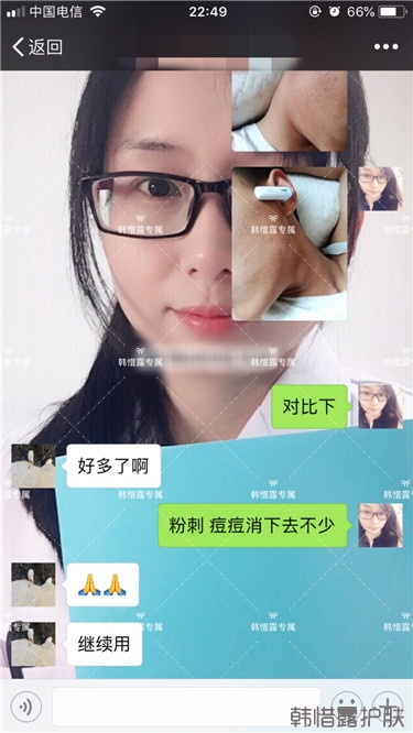 粉刺消了，皮膚光滑了，變帥氣不少呦！