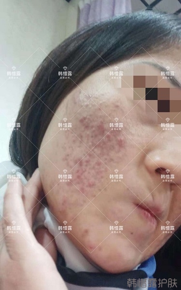 化妝品店主的變臉級祛痘反饋，粉刺痘痘全部消了