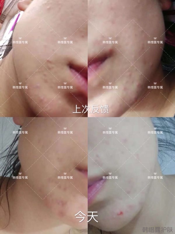 粉刺多怎么辦？按照要求配套耐心使用，粉刺消下去不少！