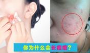 臉上長(zhǎng)痘痘是什么原因？請(qǐng)問(wèn)主要是什么原因呢？