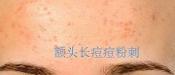 額頭長(zhǎng)痘，臉頰長(zhǎng)痘痘粉刺，就這樣恢復(fù)嫩白肌膚！