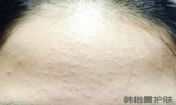 如何去除額頭的粉刺？
